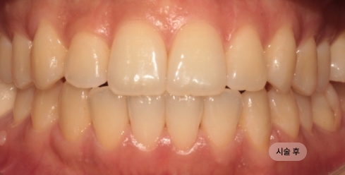 20대 여성 치아 교합 교정 치료 후 사진, 치열과 교합 개선 결과