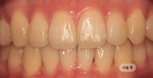 20대 여성 인비절라인 교정 치료 후 사진, 투명교정으로 치열 개선