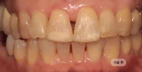 30대 여성 앞니 교정 치료 후, 앞니 배열이 고르게 정돈된 모습