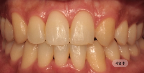 30대 남성 선천성 결손 치료 후, 공간이 보완되어 자연스러운 치열