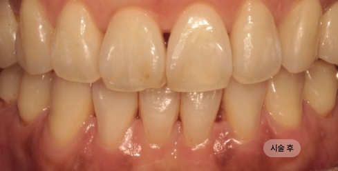 40대 여성 인비절라인 교정 치료 후 고르게 정돈된 치열과 교합