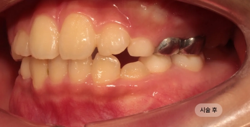 어린이 부정교합 교정 치료 후 개선된 교합과 치열 모습