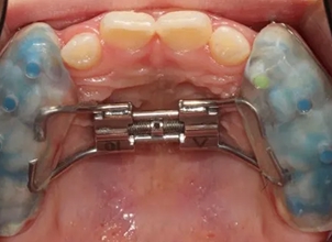 악궁확장장치와 페이스마스크, 좁은 위턱을 확장하고 전방 성장을 유도하는 교정