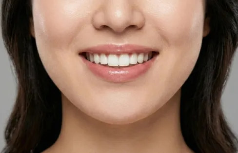 블랑쉬치과 거미스마일 보톡스 시술을 통해 웃을 때 잇몸 노출을 완화한 입 주변 이미지