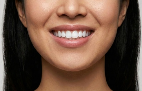 블랑쉬치과 구강전정술로 스마일 라인의 균형을 고려한 입술과 치아 이미지