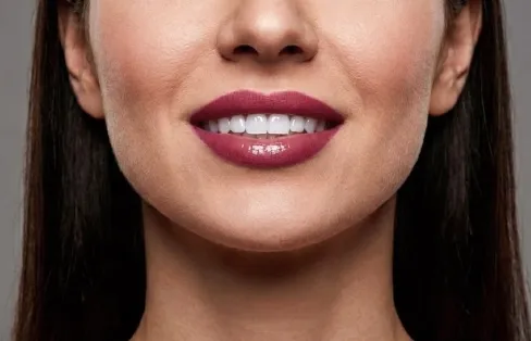 블랑쉬치과 입술 필러 시술로 입술 볼륨과 라인을 표현한 이미지