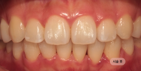 20대 남성 앞니 교정 치료 후 사진, 앞니 배열 개선 결과