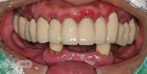 디지털 풀아치 임플란트 시술 전 구강 상태, 잇몸 염증과 치아 상실이 동반된 블랑쉬치과 치료 전 사례