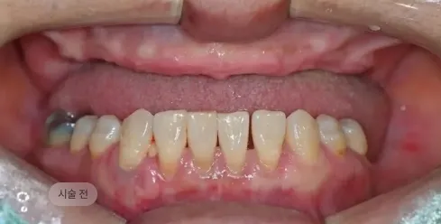 디지털 풀아치 임플란트 시술 전 하악 치아 상태, 잔존 치아와 잇몸 문제를 확인하는 블랑쉬치과 사례