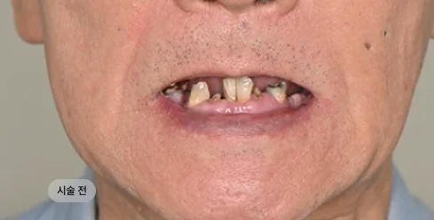 70대 남성 풀아치 임플란트 하악 시술 전 구강 상태