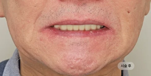 70대 남성 풀아치 임플란트 하악 시술 후 결과
