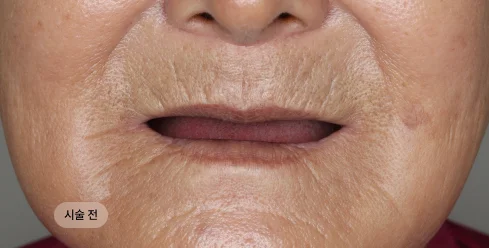 70대 여성 풀아치 임플란트 전악 시술 전 구강 상태