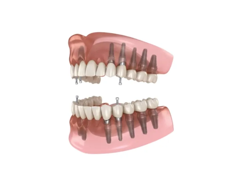 디지털 풀아치임플란트