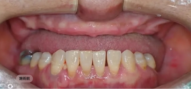 디지털 풀아치 임플란트 시술 전 구강 상태, 잇몸 염증과 치아 상실이 동반된 블랑쉬치과 치료 전 사례