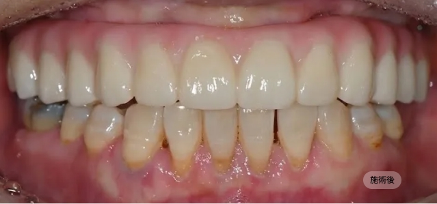 디지털 풀아치 임플란트 시술 후 모습, 저작 기능과 심미를 회복한 블랑쉬치과 치료 결과 사례