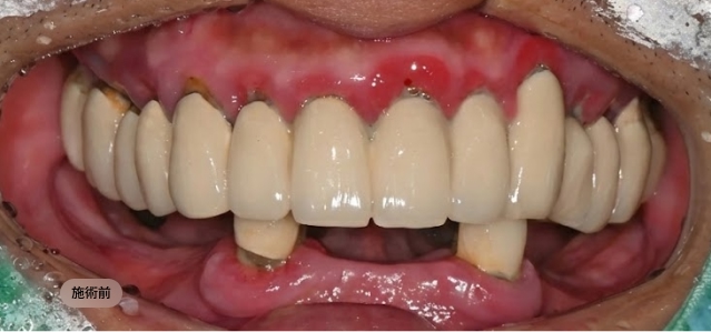 디지털 풀아치 임플란트 시술 전 하악 치아 상태, 잔존 치아와 잇몸 문제를 확인하는 블랑쉬치과 사례