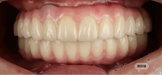 디지털 풀아치 임플란트 시술 후 하악 전악 복원 모습, 안정적인 교합을 완성한 블랑쉬치과 사례