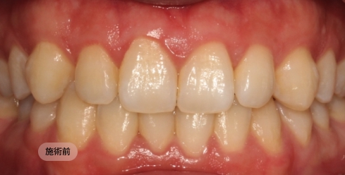 20代男性の前歯矯正治療前の写真