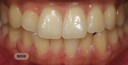 20代女性の歯列咬合矯正治療前の写真