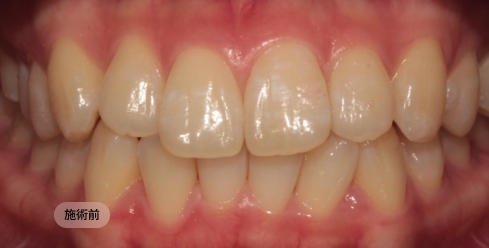 20代女性のインビザライン矯正治療前の写真