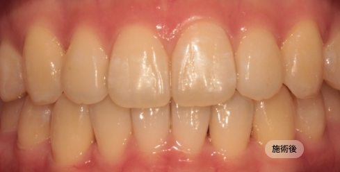 20代女性のインビザライン矯正治療後の写真
