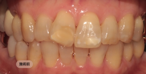 30代女性の前歯矯正治療前