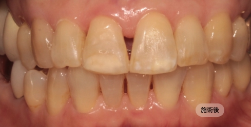 30代女性の前歯矯正治療後