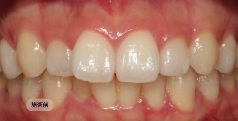 30代男性の前歯矯正治療前
