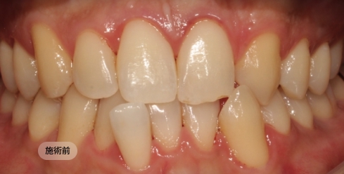 30代男性の先天性欠損治療前