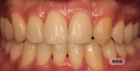 30代男性の先天性欠損治療後