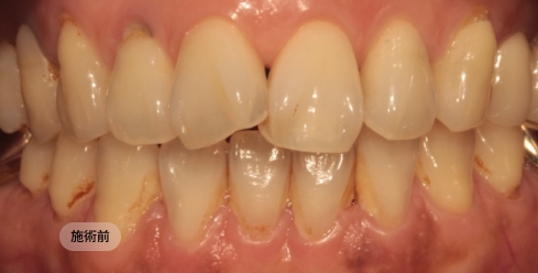 40代女性のインビザライン矯正治療前