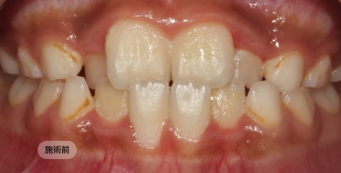 10代女性のインビザライン矯正治療前