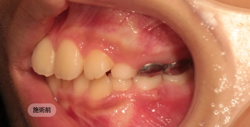 小児、不正咬合矯正治療前