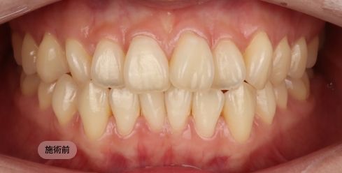 30代女性のホワイトニング前の写真
