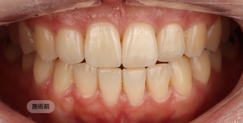 20代女性のホワイトニング前の写真