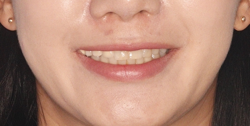 라미네이트 재시술