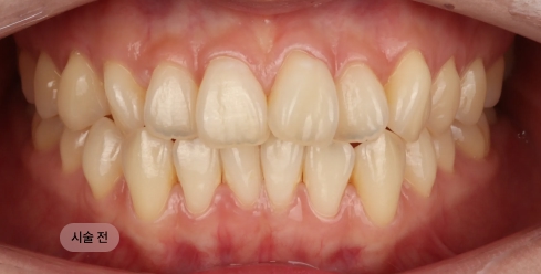 30대 여성 치아미백 시술 전, 전체적으로 어두운 치아 톤으로 웃을 때 인상이 흐려 보이는 상태