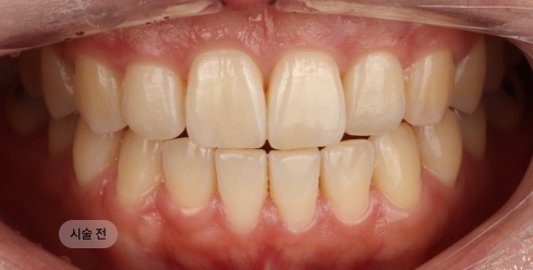 20대 여성 치아미백 시술 전, 누런 치아 색으로 인해 치아가 칙칙해 보이는 상태