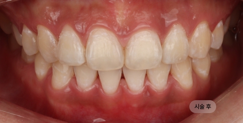 30대 여성 치아미백 시술 후, 착색이 제거되어 깔끔하고 균일한 치아 인상이 완성된 모습