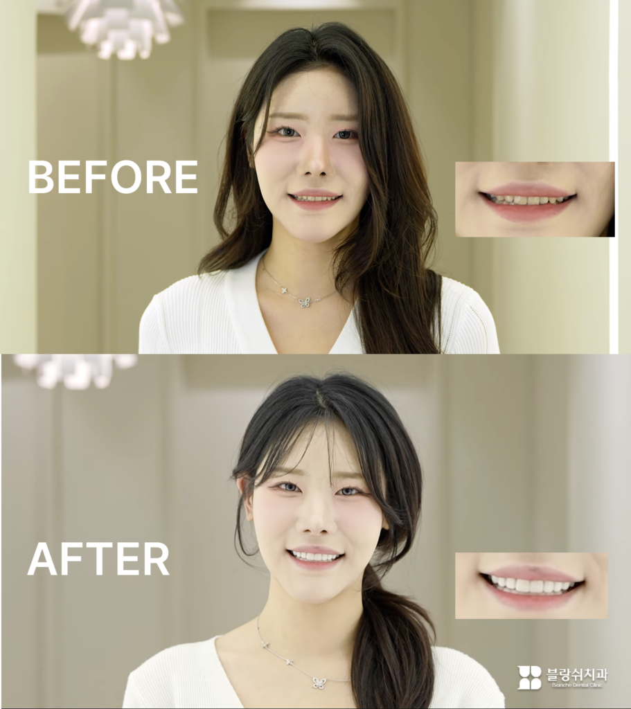 블랑쉬 누런 치아 시술 사례