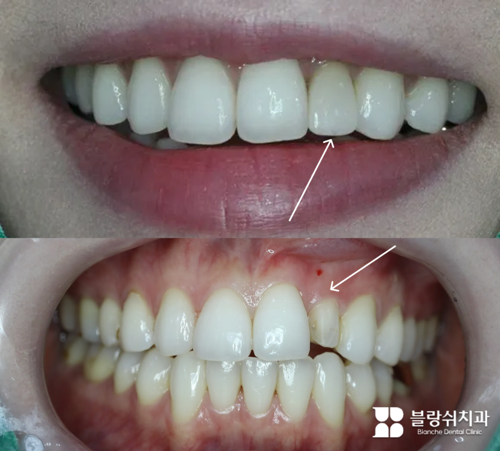 앞니 기존 라미네이트 제거 후 법랑질이 많이 삭제된 상태
