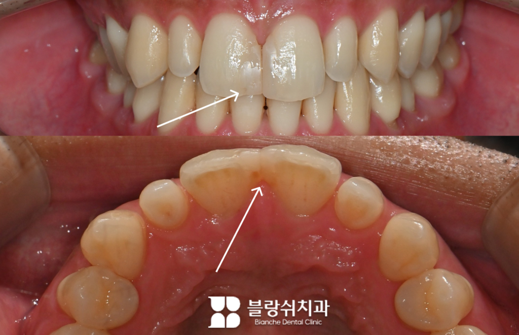 앞니 다이아스테마를 레진으로 막은 상태에서 레진 경계가 보이는 전치부 사진
