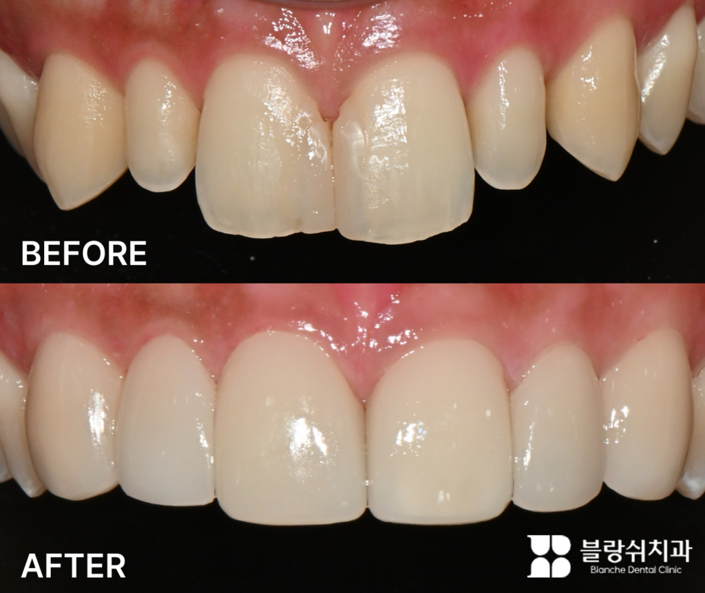앞니 레진 수복과 왜소치를 라미네이트로 교체해 치열과 색감을 개선한 모습