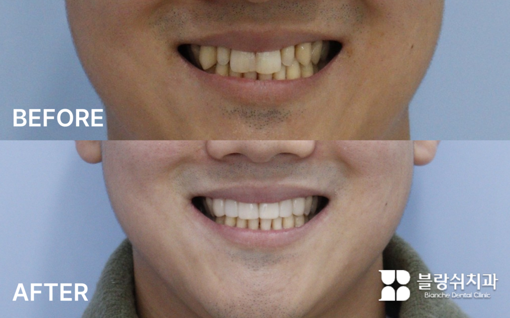 앞니 왜소치와 레진 수복을 라미네이트로 개선한 안모 전후 비교 사진