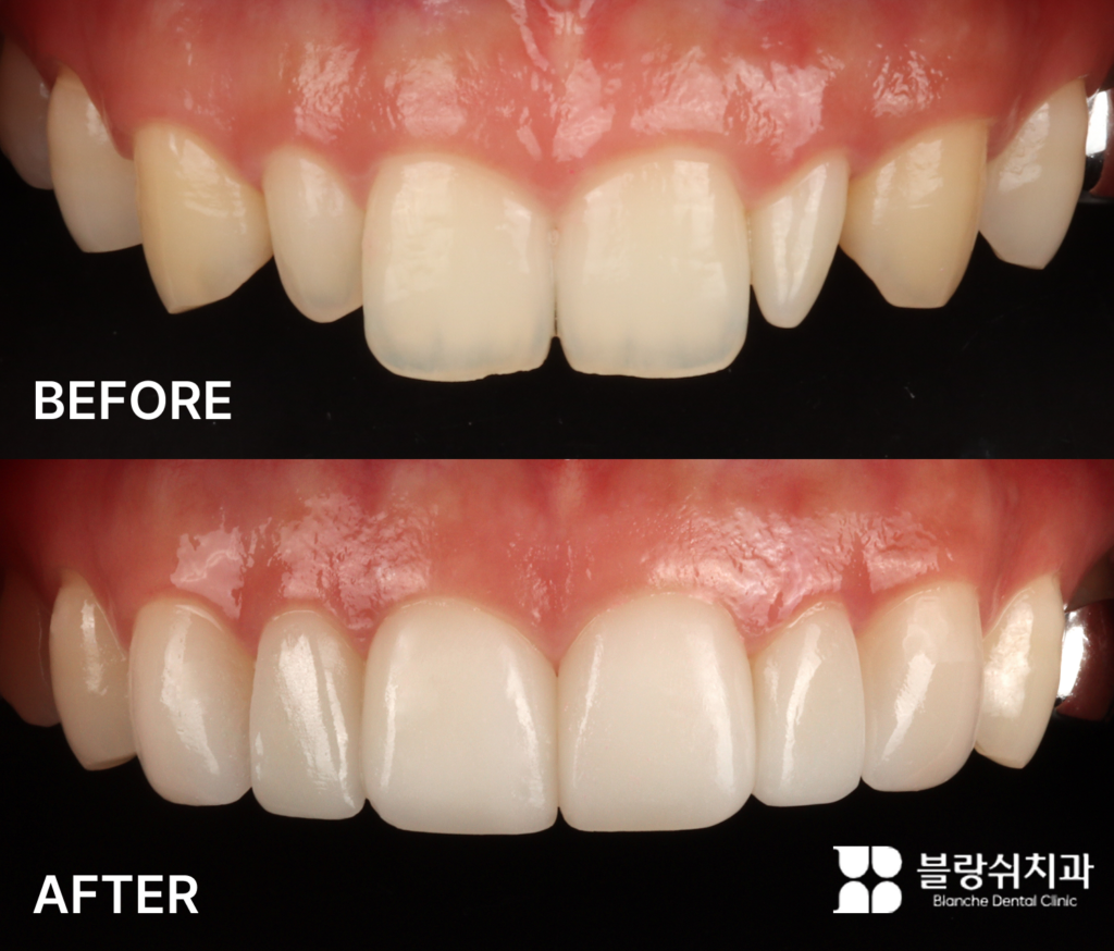 양측 왜소치를 최소삭제 라미네이트로 채워 스마일 라인을 개선한 모습