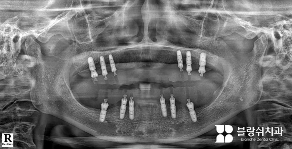 스트라우만 BLX 임플란트 즉시 식립 사례